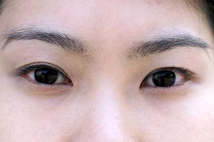 大阪で刺青除去が評判のクリニック